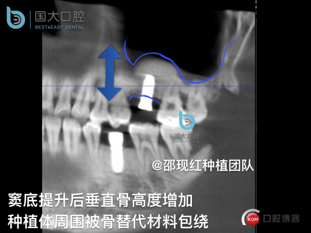 王元超 左上6上颌窦外提升 骨粉植骨术.031.jpeg