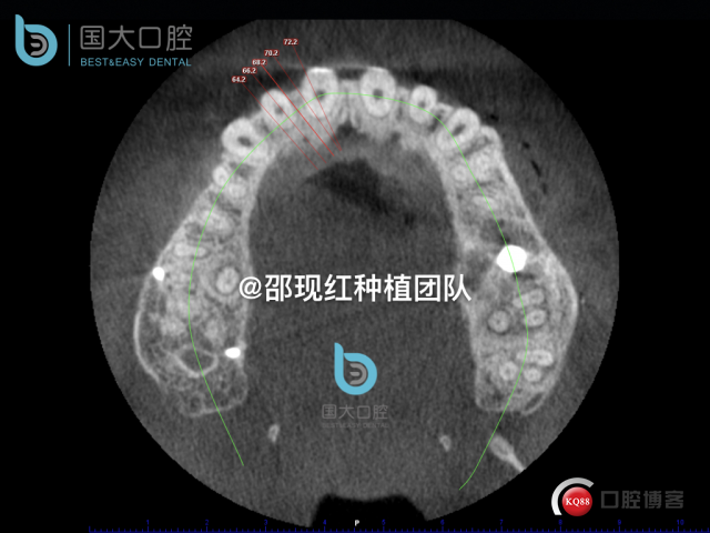 王元超 左上6上颌窦外提升 骨粉植骨术.032.jpeg