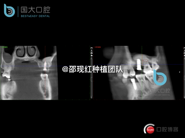 王元超 左上6上颌窦外提升 骨粉植骨术.033.jpeg