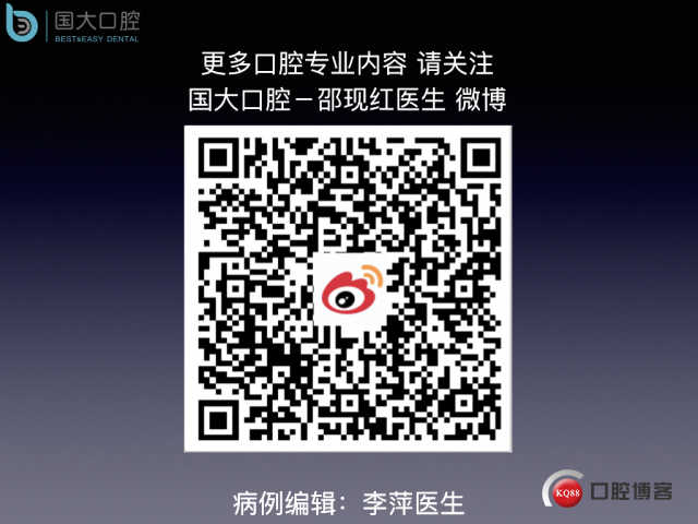 王元超 左上6上颌窦外提升 骨粉植骨术.034.jpeg