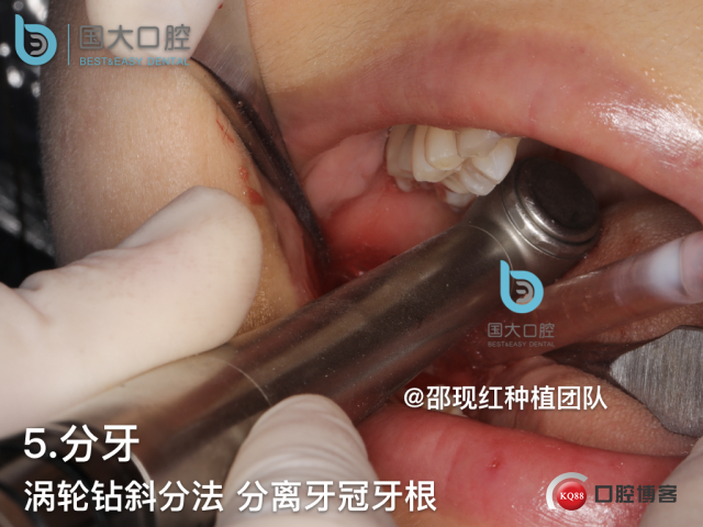 王艳华 右下8智齿拔除 骨胶原 .028.jpeg