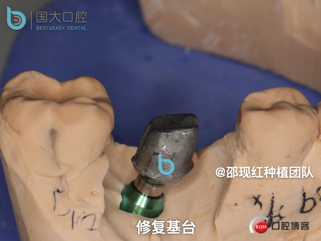 金永生 右下6百康即刻种植 假壁 植骨.037.jpeg