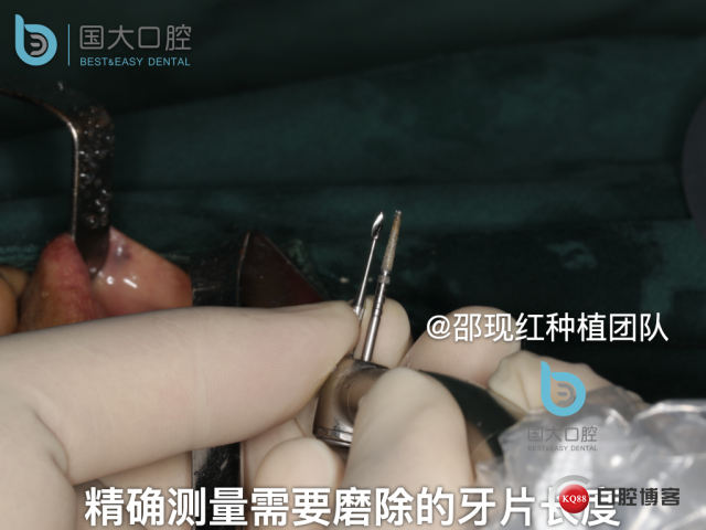 郭牧 kq88发布版右上1牙片保留术 CORTEX 骨胶原 骨粉 植骨术_副本.013.jpeg