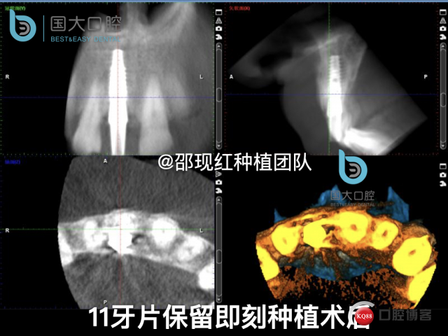 郭牧 kq88发布版右上1牙片保留术 CORTEX 骨胶原 骨粉 植骨术_副本.031.jpeg