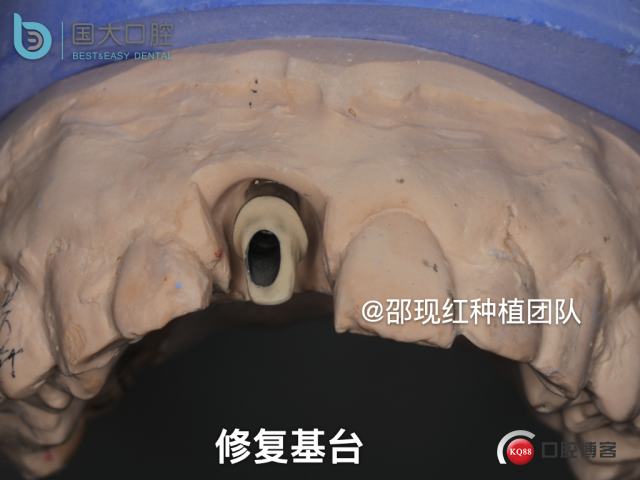 郭牧 kq88发布版右上1牙片保留术 CORTEX 骨胶原 骨粉 植骨术_副本.045.jpeg
