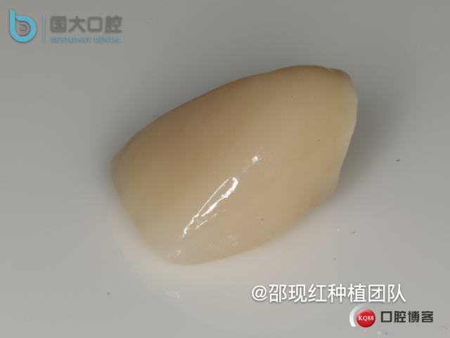 郭牧 kq88发布版右上1牙片保留术 CORTEX 骨胶原 骨粉 植骨术_副本.050.jpeg