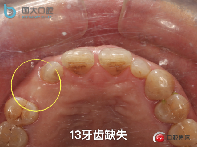 周晶 右上3数字化导板种植 以终为始的导板种植 sic导板 放射假牙，蜡牙 美学种植.004.jpeg