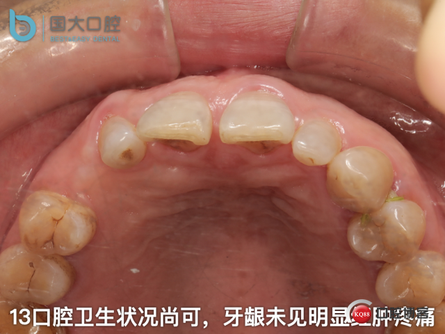 周晶 右上3数字化导板种植 以终为始的导板种植 sic导板 放射假牙，蜡牙 美学种植.005.jpeg