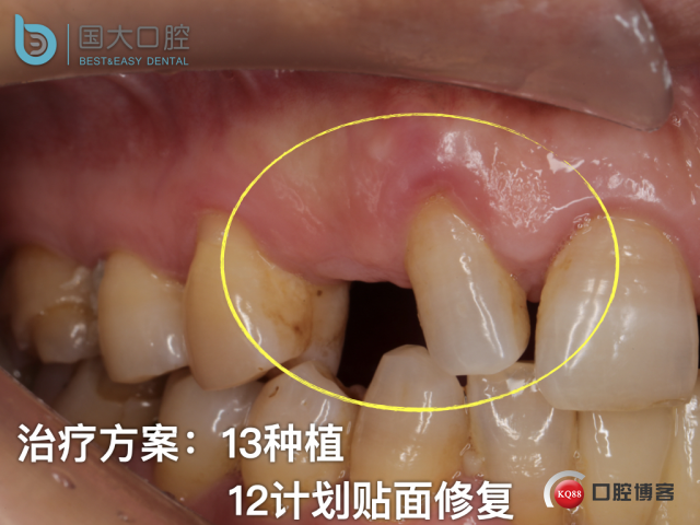 周晶 右上3数字化导板种植 以终为始的导板种植 sic导板 放射假牙，蜡牙 美学种植.006.jpeg