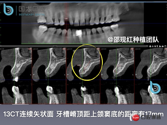 周晶 右上3数字化导板种植 以终为始的导板种植 sic导板 放射假牙，蜡牙 美学种植.007.jpeg