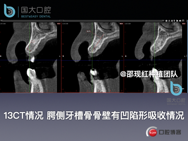 周晶 右上3数字化导板种植 以终为始的导板种植 sic导板 放射假牙，蜡牙 美学种植.008.jpeg