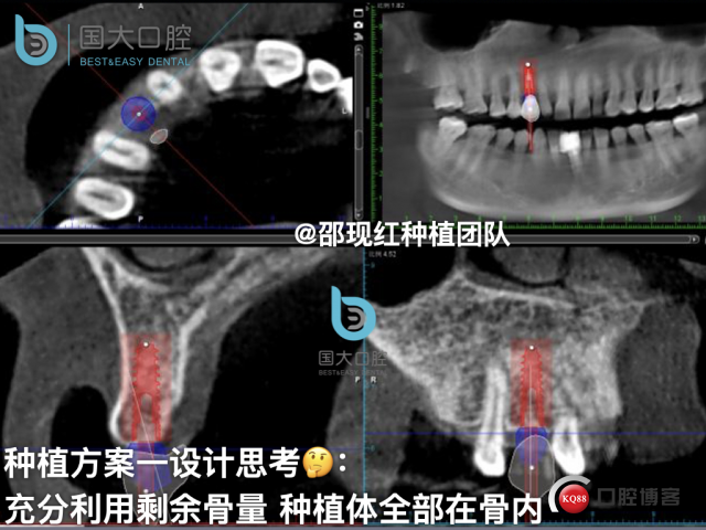 周晶 右上3数字化导板种植 以终为始的导板种植 sic导板 放射假牙，蜡牙 美学种植.009.jpeg