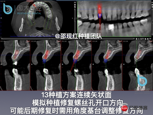 周晶 右上3数字化导板种植 以终为始的导板种植 sic导板 放射假牙，蜡牙 美学种植.010.jpeg