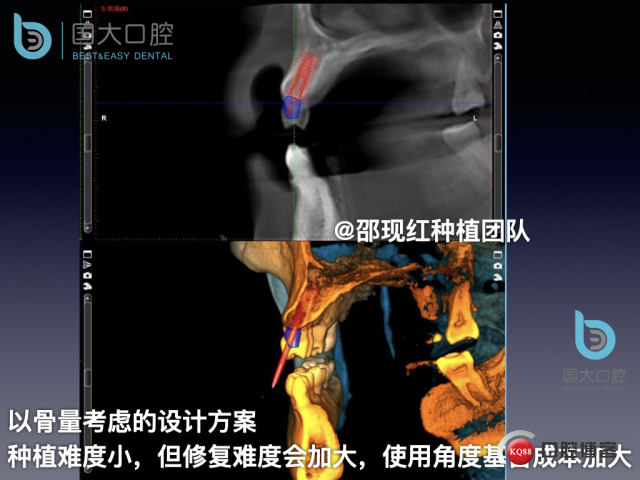 周晶 右上3数字化导板种植 以终为始的导板种植 sic导板 放射假牙，蜡牙 美学种植.011.jpeg
