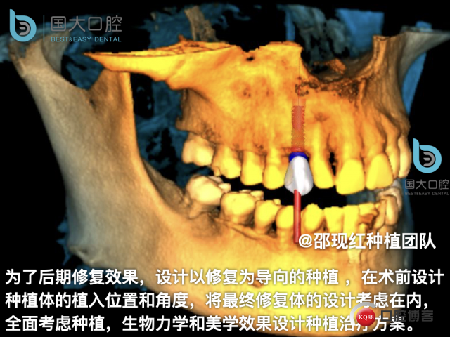 周晶 右上3数字化导板种植 以终为始的导板种植 sic导板 放射假牙，蜡牙 美学种植.012.jpeg