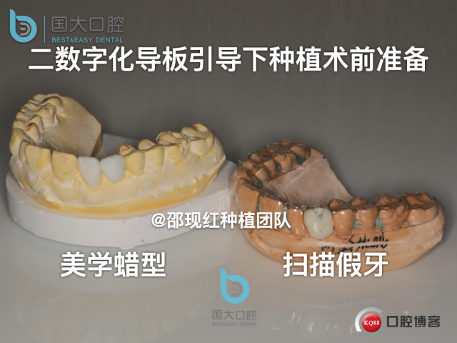 周晶 右上3数字化导板种植 以终为始的导板种植 sic导板 放射假牙，蜡牙 美学种植.013.jpeg