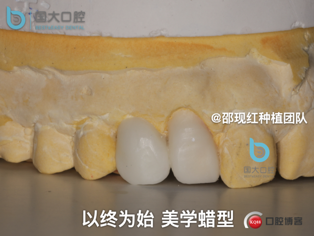 周晶 右上3数字化导板种植 以终为始的导板种植 sic导板 放射假牙，蜡牙 美学种植.014.jpeg