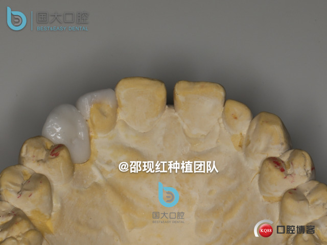 周晶 右上3数字化导板种植 以终为始的导板种植 sic导板 放射假牙，蜡牙 美学种植.015.jpeg