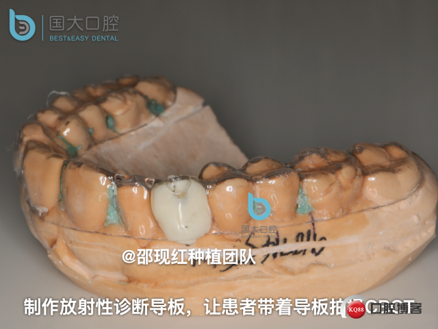 周晶 右上3数字化导板种植 以终为始的导板种植 sic导板 放射假牙，蜡牙 美学种植.016.jpeg