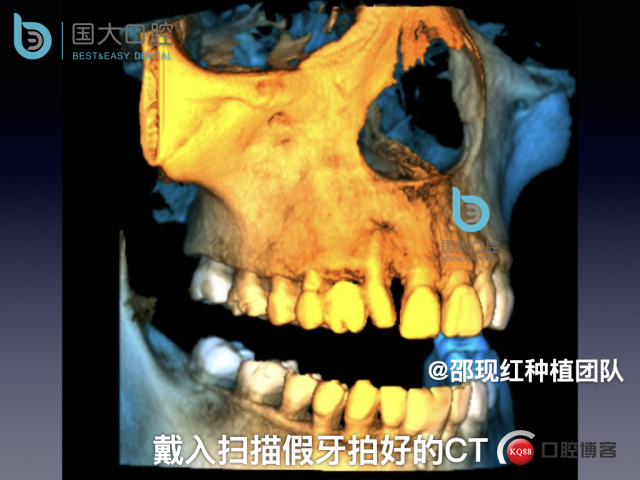 周晶 右上3数字化导板种植 以终为始的导板种植 sic导板 放射假牙，蜡牙 美学种植.017.jpeg