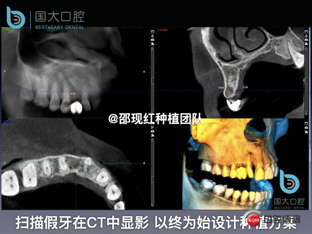 周晶 右上3数字化导板种植 以终为始的导板种植 sic导板 放射假牙，蜡牙 美学种植.018.jpeg