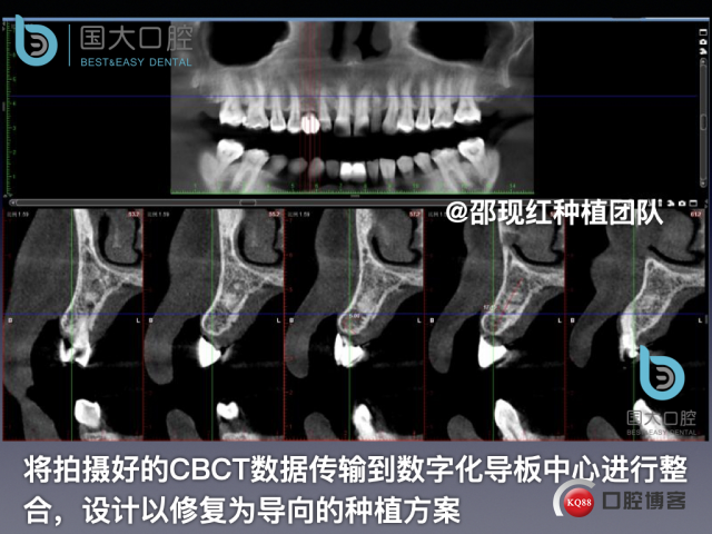 周晶 右上3数字化导板种植 以终为始的导板种植 sic导板 放射假牙，蜡牙 美学种植.019.jpeg