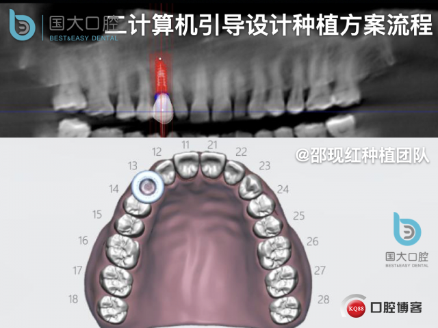周晶 右上3数字化导板种植 以终为始的导板种植 sic导板 放射假牙，蜡牙 美学种植.020.jpeg