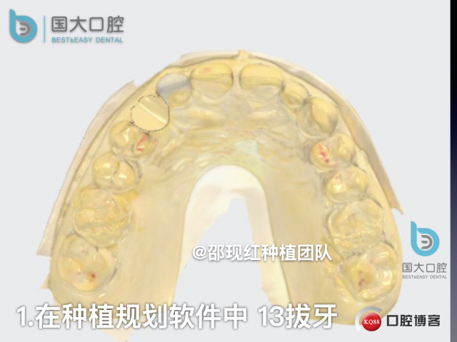 周晶 右上3数字化导板种植 以终为始的导板种植 sic导板 放射假牙，蜡牙 美学种植.021.jpeg
