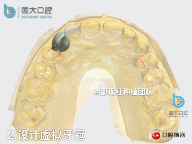 周晶 右上3数字化导板种植 以终为始的导板种植 sic导板 放射假牙，蜡牙 美学种植.022.jpeg