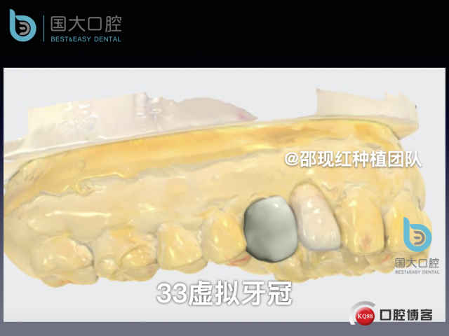 周晶 右上3数字化导板种植 以终为始的导板种植 sic导板 放射假牙，蜡牙 美学种植.023.jpeg