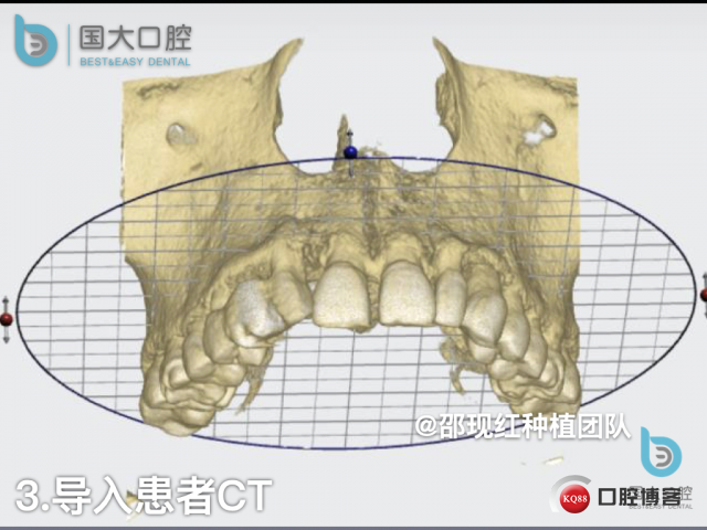 周晶 右上3数字化导板种植 以终为始的导板种植 sic导板 放射假牙，蜡牙 美学种植.024.jpeg