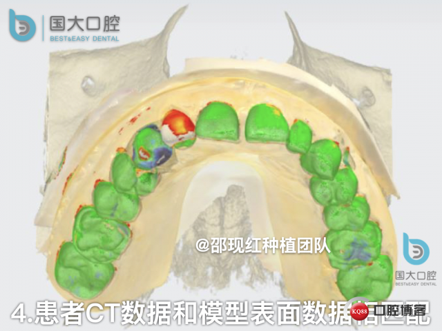 周晶 右上3数字化导板种植 以终为始的导板种植 sic导板 放射假牙，蜡牙 美学种植.025.jpeg