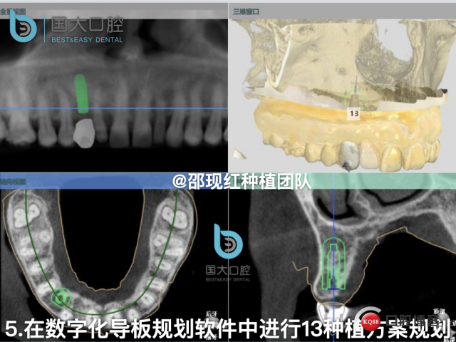 周晶 右上3数字化导板种植 以终为始的导板种植 sic导板 放射假牙，蜡牙 美学种植.026.jpeg