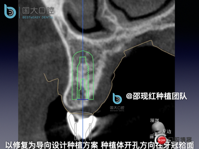 周晶 右上3数字化导板种植 以终为始的导板种植 sic导板 放射假牙，蜡牙 美学种植.027.jpeg