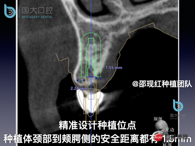周晶 右上3数字化导板种植 以终为始的导板种植 sic导板 放射假牙，蜡牙 美学种植.028.jpeg