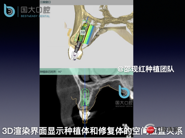 周晶 右上3数字化导板种植 以终为始的导板种植 sic导板 放射假牙，蜡牙 美学种植.029.jpeg