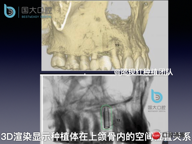 周晶 右上3数字化导板种植 以终为始的导板种植 sic导板 放射假牙，蜡牙 美学种植.030.jpeg