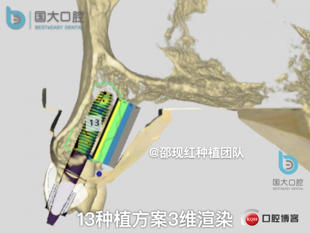 周晶 右上3数字化导板种植 以终为始的导板种植 sic导板 放射假牙，蜡牙 美学种植.031.jpeg