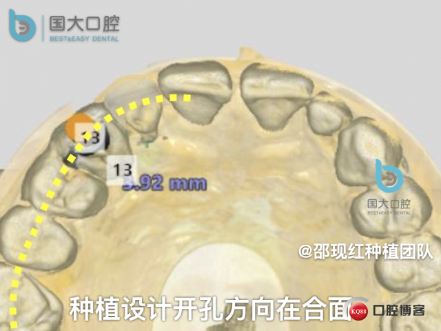 周晶 右上3数字化导板种植 以终为始的导板种植 sic导板 放射假牙，蜡牙 美学种植.032.jpeg