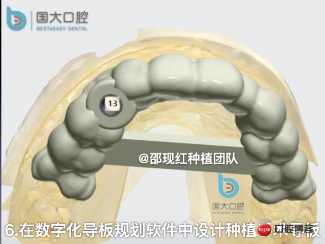 周晶 右上3数字化导板种植 以终为始的导板种植 sic导板 放射假牙，蜡牙 美学种植.033.jpeg