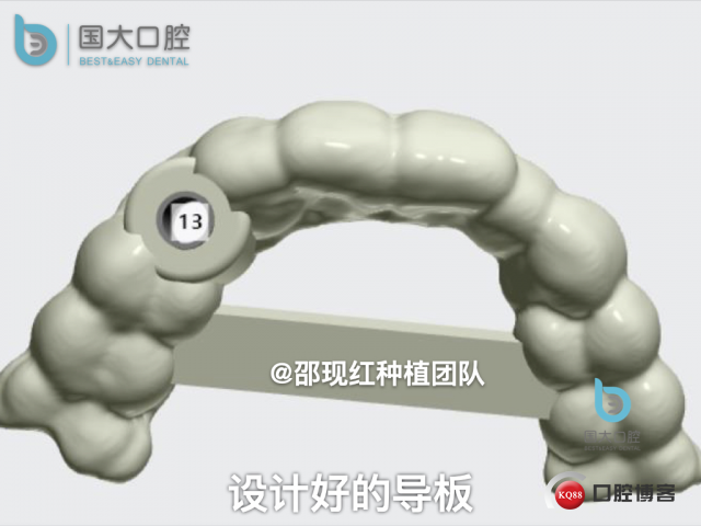 周晶 右上3数字化导板种植 以终为始的导板种植 sic导板 放射假牙，蜡牙 美学种植.034.jpeg