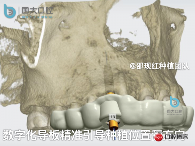 周晶 右上3数字化导板种植 以终为始的导板种植 sic导板 放射假牙，蜡牙 美学种植.035.jpeg