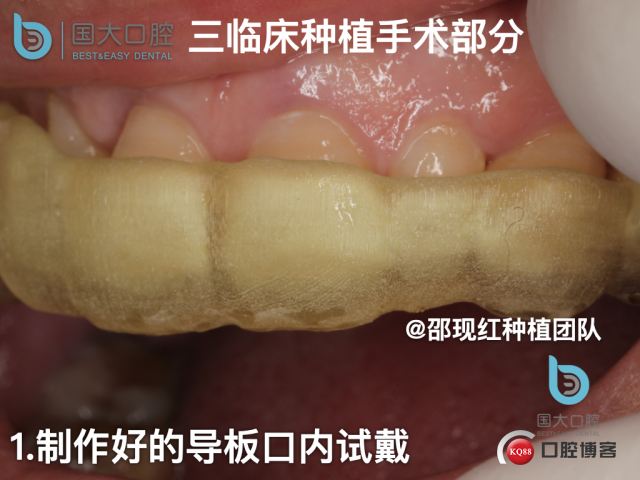 周晶 右上3数字化导板种植 以终为始的导板种植 sic导板 放射假牙，蜡牙 美学种植.036.jpeg