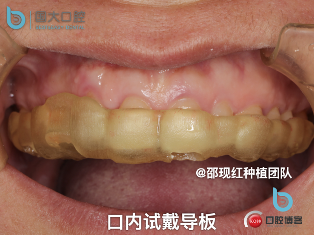 周晶 右上3数字化导板种植 以终为始的导板种植 sic导板 放射假牙，蜡牙 美学种植.037.jpeg