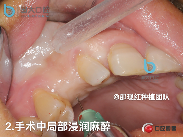 周晶 右上3数字化导板种植 以终为始的导板种植 sic导板 放射假牙，蜡牙 美学种植.038.jpeg