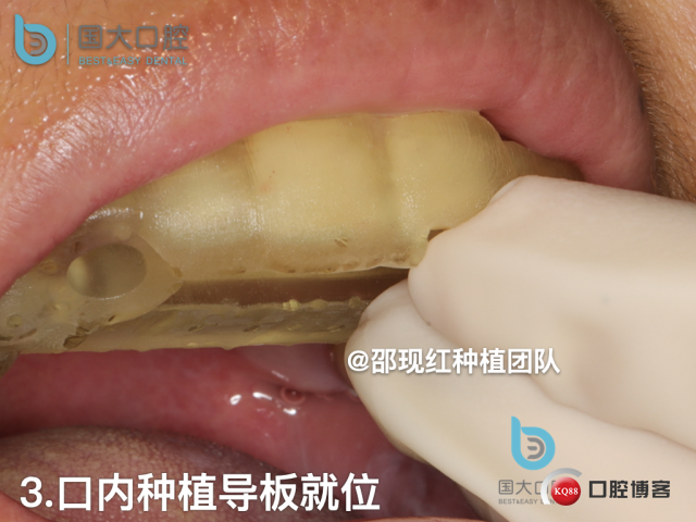 周晶 右上3数字化导板种植 以终为始的导板种植 sic导板 放射假牙，蜡牙 美学种植.039.jpeg