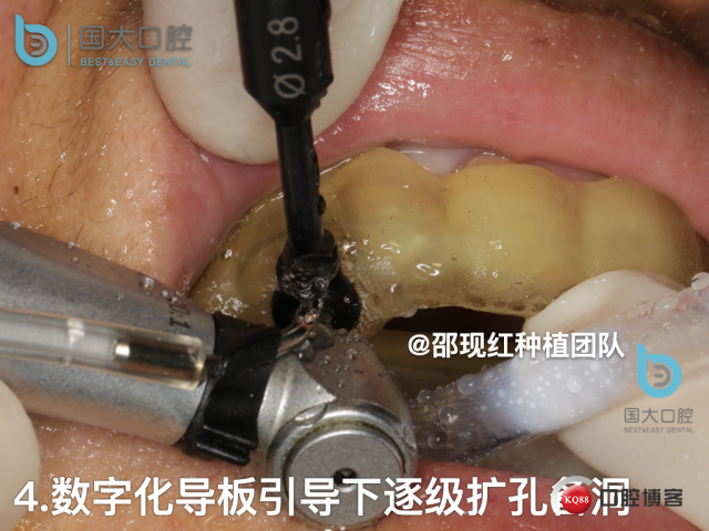 周晶 右上3数字化导板种植 以终为始的导板种植 sic导板 放射假牙，蜡牙 美学种植.040.jpeg