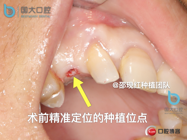 周晶 右上3数字化导板种植 以终为始的导板种植 sic导板 放射假牙，蜡牙 美学种植.041.jpeg