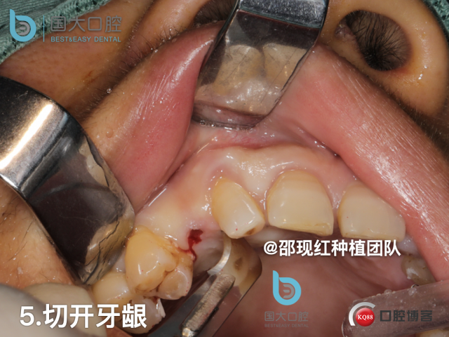 周晶 右上3数字化导板种植 以终为始的导板种植 sic导板 放射假牙，蜡牙 美学种植.042.jpeg