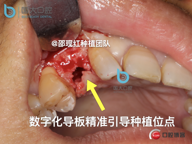 周晶 右上3数字化导板种植 以终为始的导板种植 sic导板 放射假牙，蜡牙 美学种植.044.jpeg